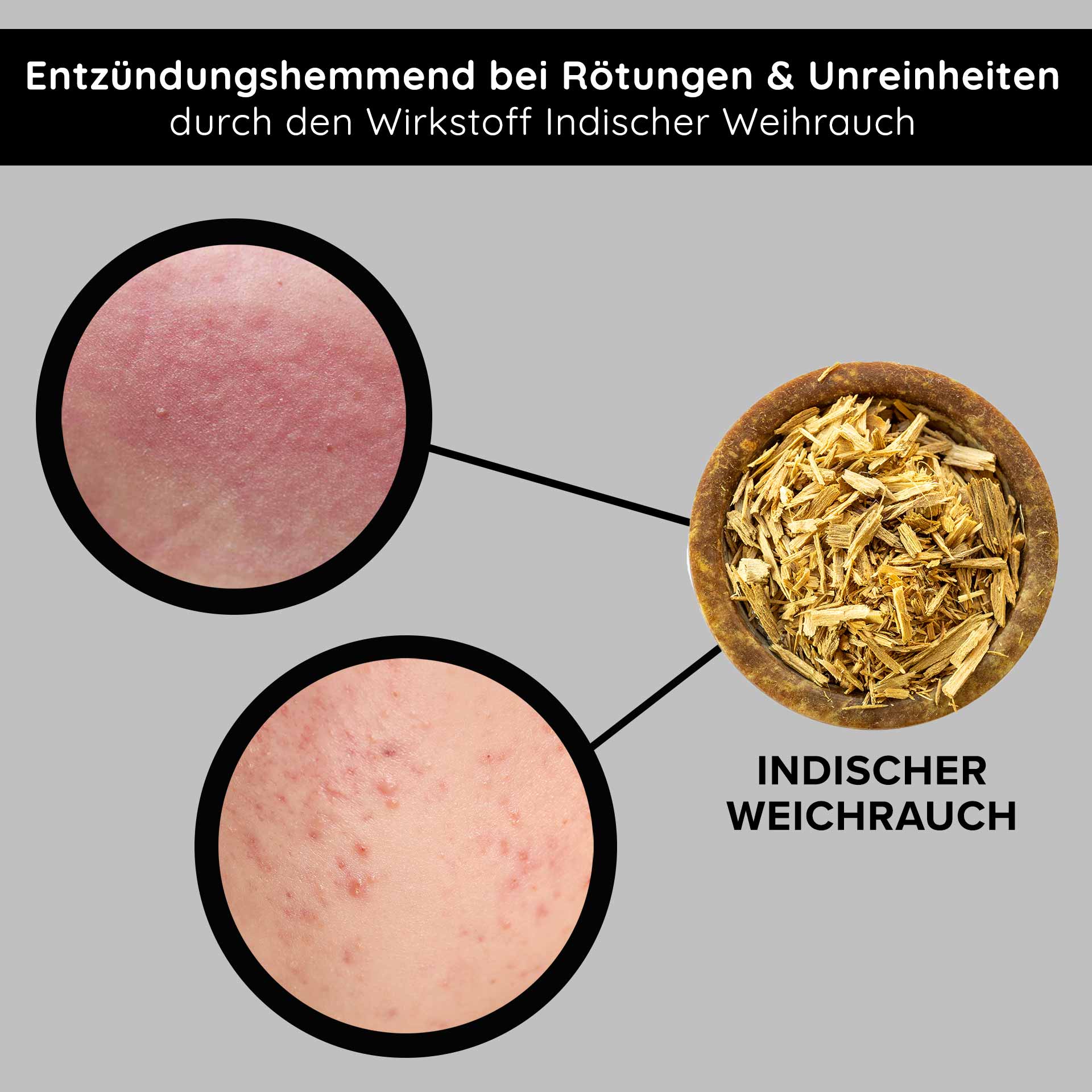 Entzündungshemmendes Indischer Weihrauch zur Reduzierung von Rötungen und Unreinheiten, mit Nahaufnahmen von betroffener Haut.