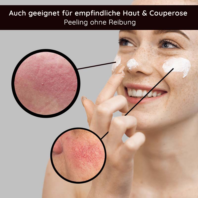 Fruit Acid Peeling 100 ml Fruchtsäurepeeling mit BHA Frau mit fröhlichem Gesicht, die Fruchtsäurepeeling auf die Haut aufträgt, um empfindliche Haut und Couperose zu behandeln, mit Nahaufnahmen von geröteter Haut und Peelingeffekten.
